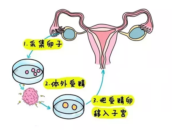 多囊卵巢综合征